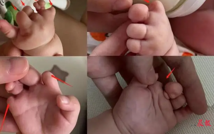 孕妇贫血